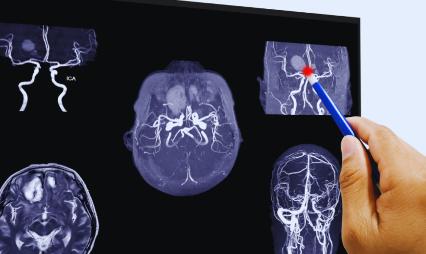 Tipos de hemorragia intracraniana