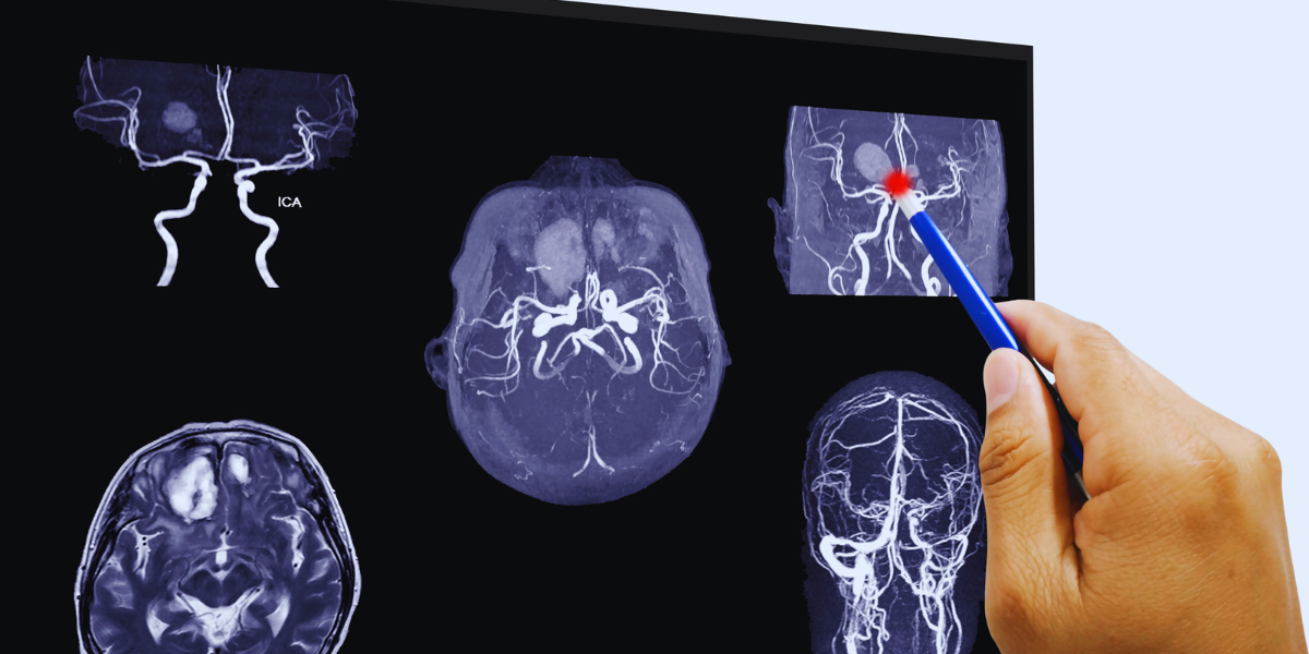 Tipos de hemorragia intracraniana